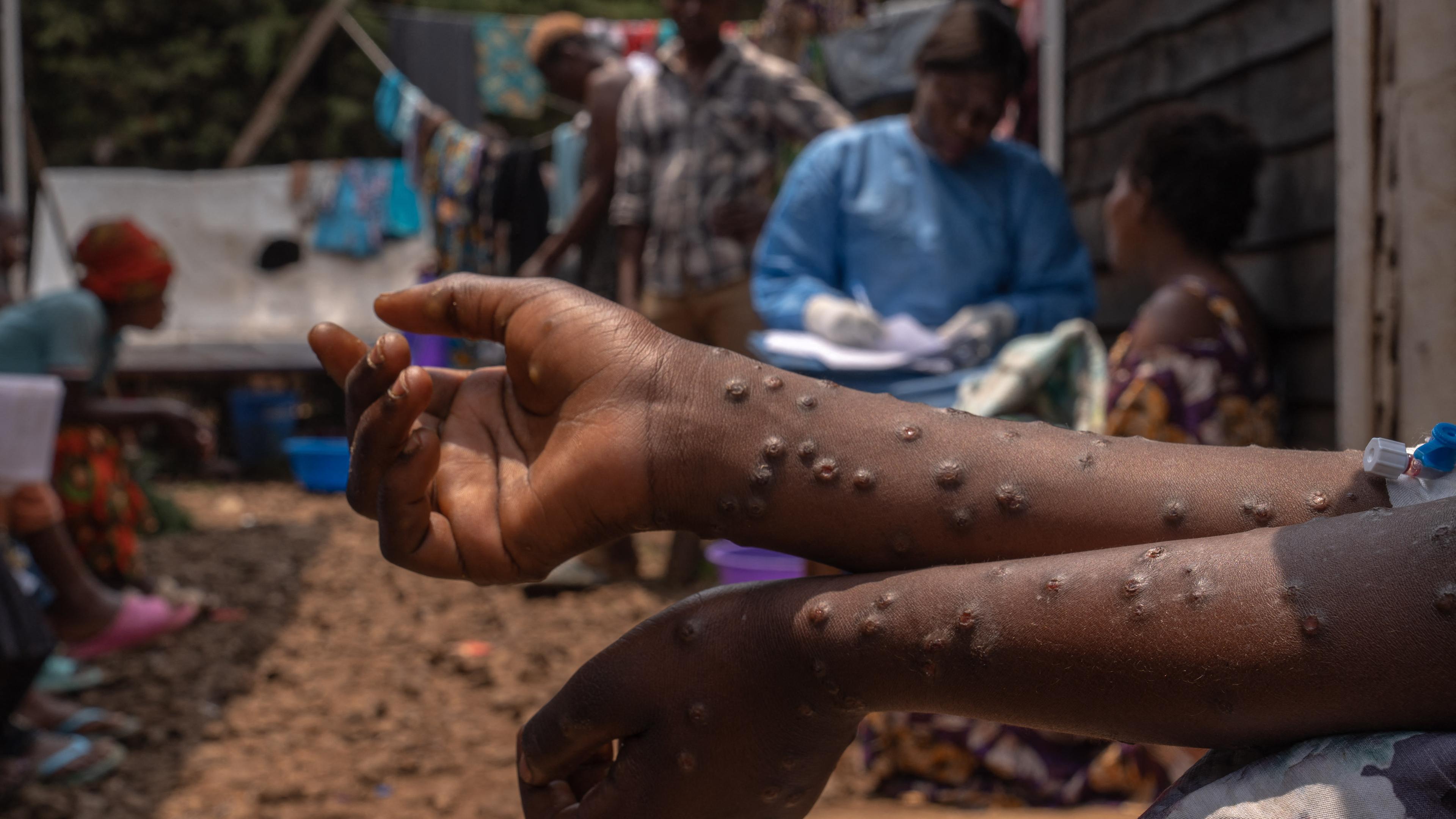 Ausgestreckte Arme mit sichtbarem MPOX Ausschlag