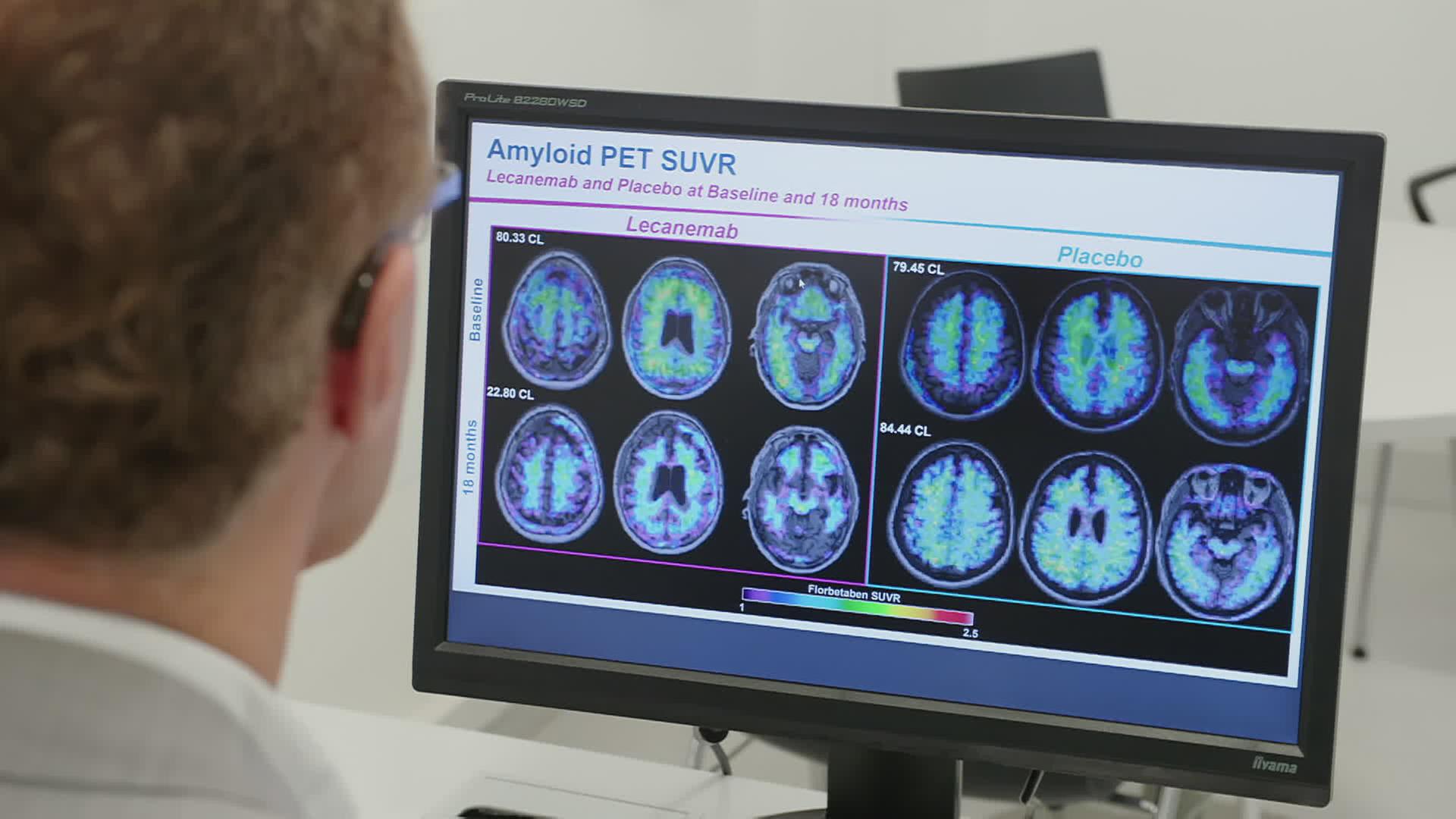 Mediziner blickt auf Computermonitor, auf dem Schaubilder des Gehirns zu sehen sind, die die Wirkung von Lecanemab im Vergleich zum Placebo abbilden.