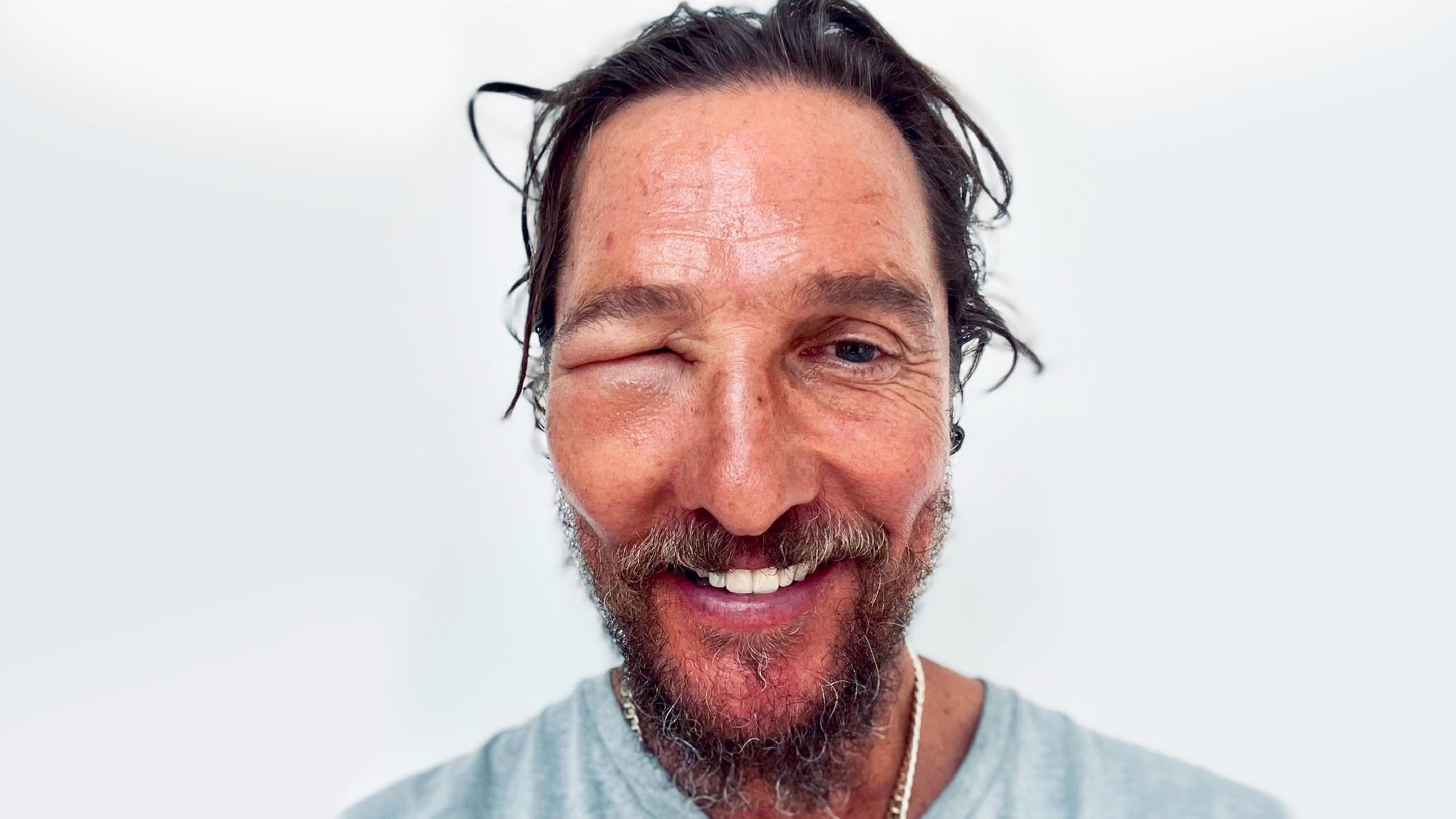 Matthew McConaughey ist richtig böse von einer Biene gestochen worden und nimmt’s mit Humor: Auf seinem Instagram-Kanal präsentiert er das zugeschwollene Auge. (11.07.2024)