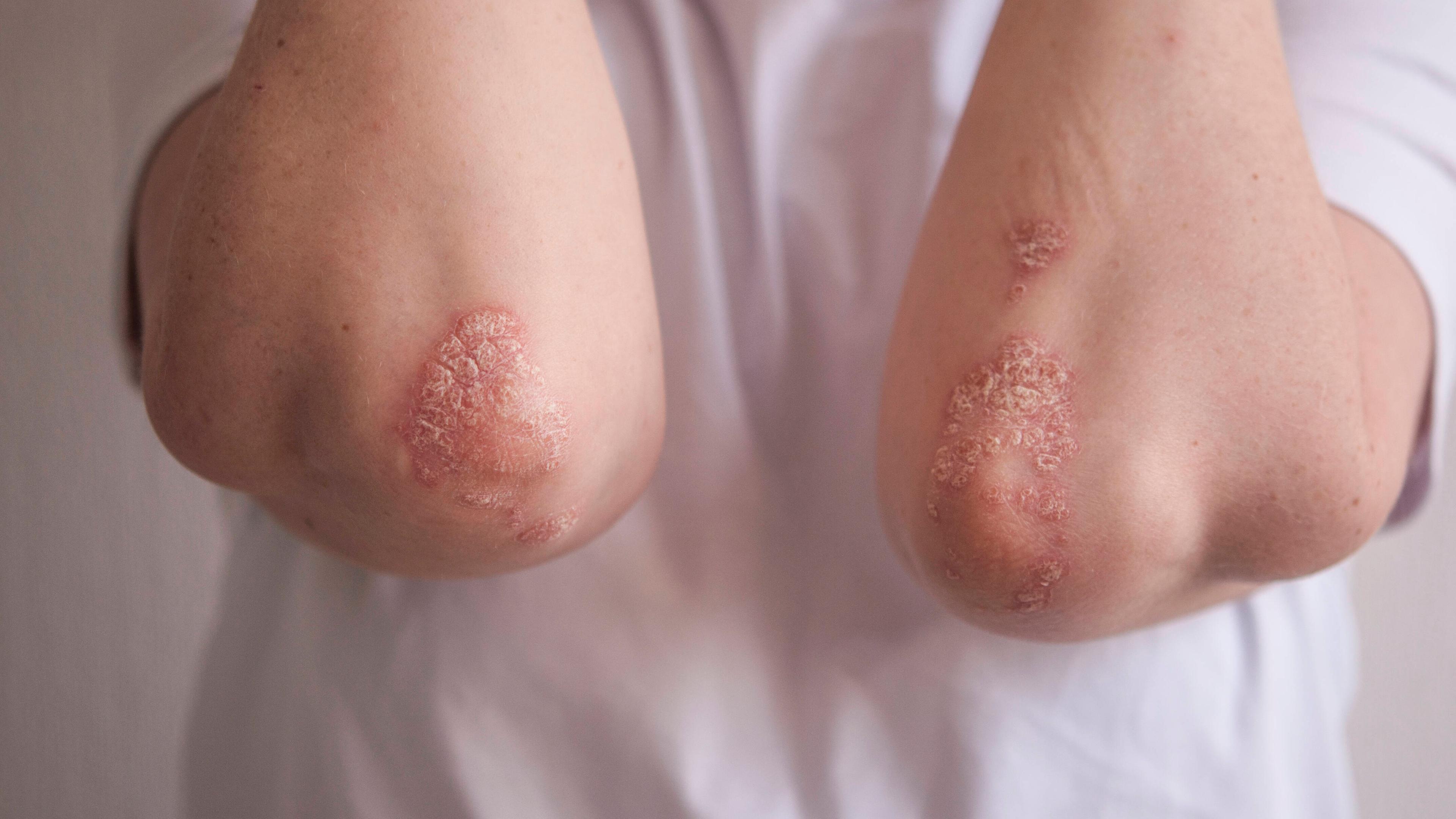 An den Ellenbogen eines Betroffenen sind die typischen roten und schuppenden Hautstellen der Psoriasis, einer Schuppenflechte deutlich zu sehen.