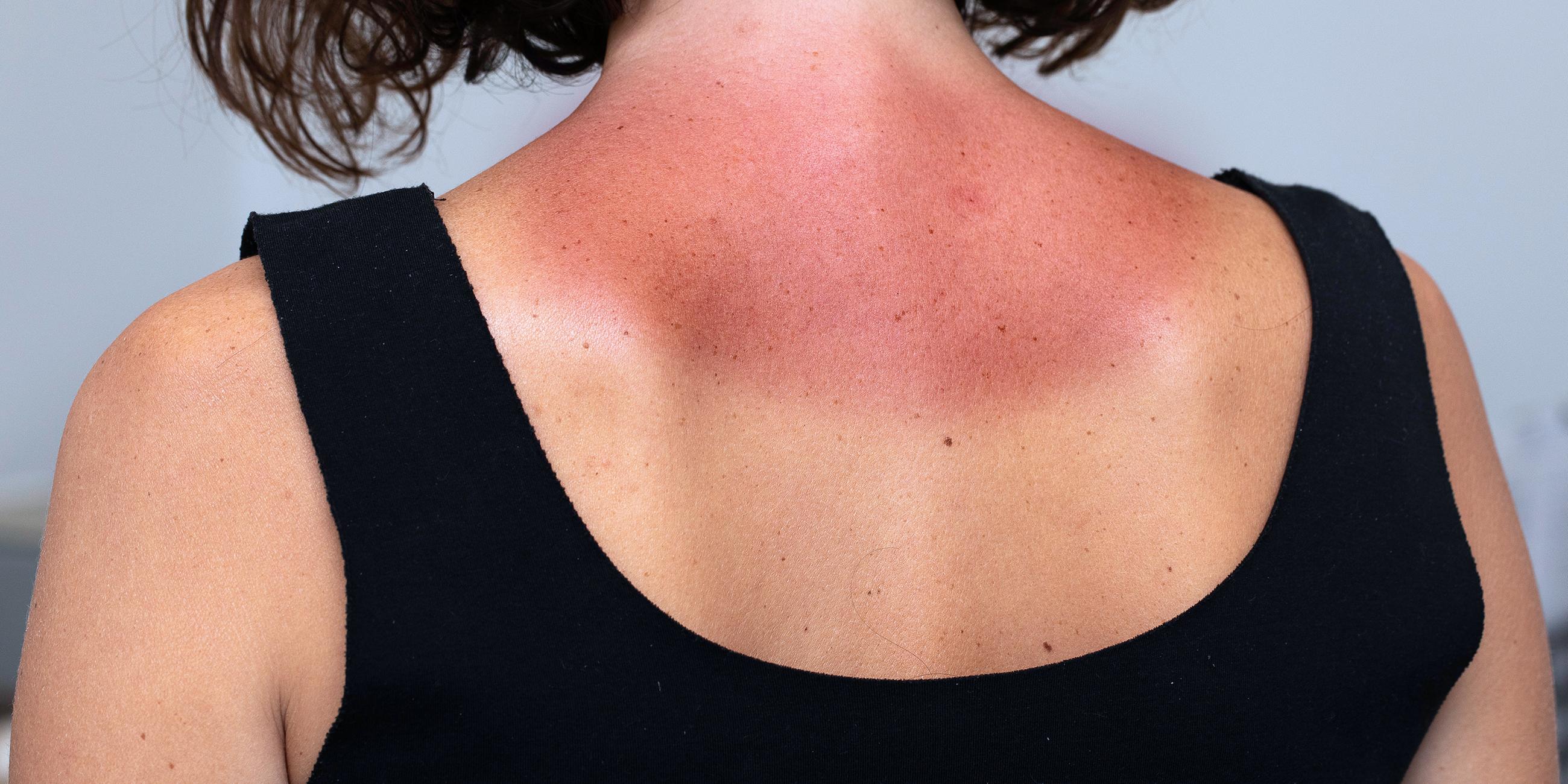 Junge Frau mit starken Rötungen und schmerzhafter Haut im Nackenbereich nach Sonnenbaden.