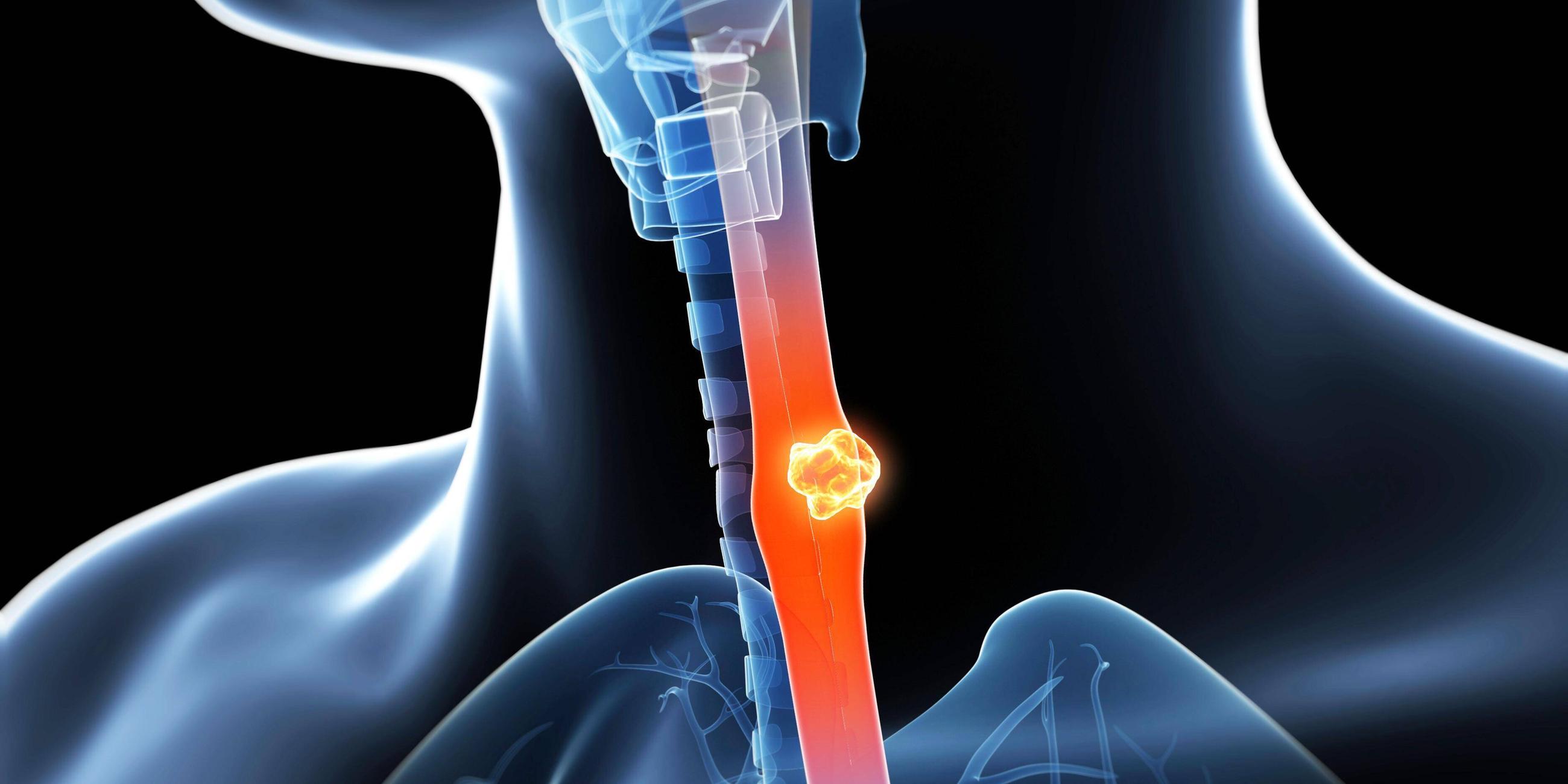 Eine 3D-animierte Illustration von Speiseröhrenkrebs.