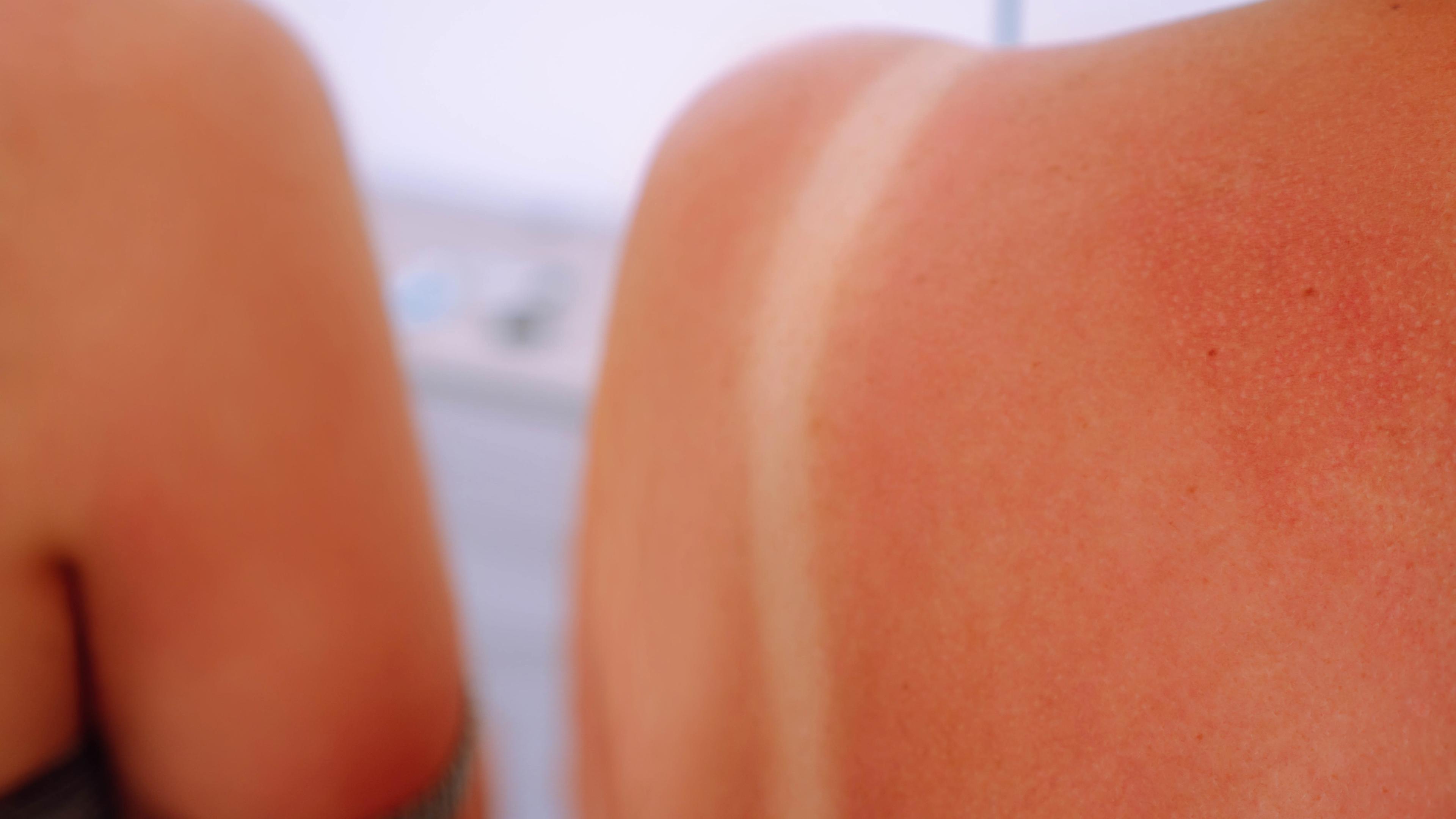 Frau mit Sonnenbrand an der Schulter 